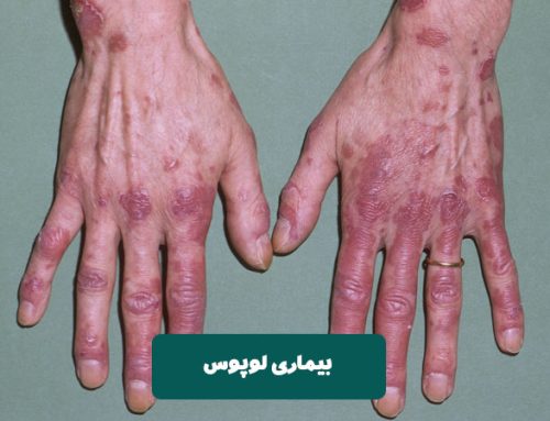 بیماری لوپوس چیست و چه علائمی دارد؟