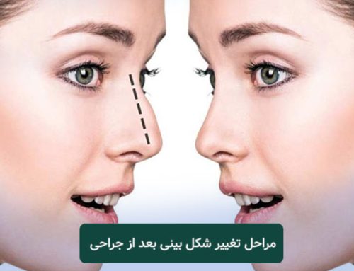 مراحل تغییر شکل بینی بعد از عمل